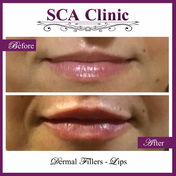 Dermal Fillers - Lips